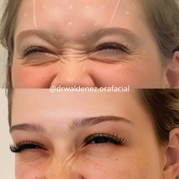 Foto do antes e depois de uma paciente que realizou toxina botulínica (botox) nas rugas do nariz com o Dr Waldenez