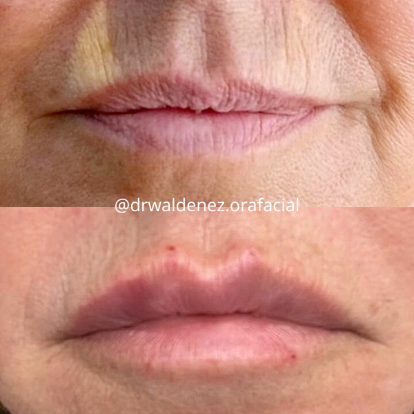 Foto do antes e depois de uma paciente que realizou preenchimento labial com o Dr Waldenez