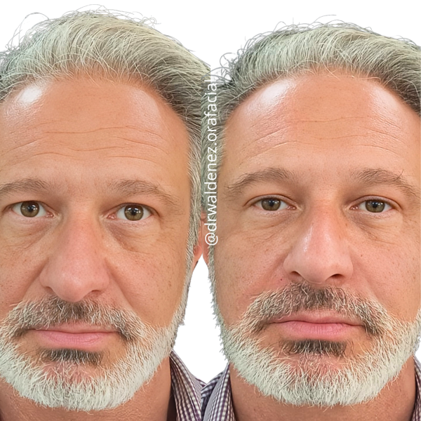 Foto do antes e depois de uma paciente que realizou tratamento para o bigode chinês e realce do contorno facial com o Dr Waldenez