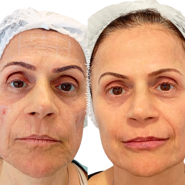 O único bioestimulador de colágeno, 100% natural e seguro, é o PRP - Plasma Rico em Plaquetas, obtido através do sangue do próprio paciente. Ideal para um rejuvenescimento gradativo, tratando a pele de dentro para fora, recuperando a perda do colágeno, a elastina e o brilho da pele.
