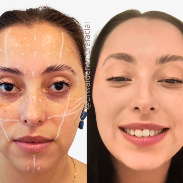 Foto do antes e depois de uma paciente que realizou tratamento para as olheiras e realce do contorno facial com o Dr Waldenez